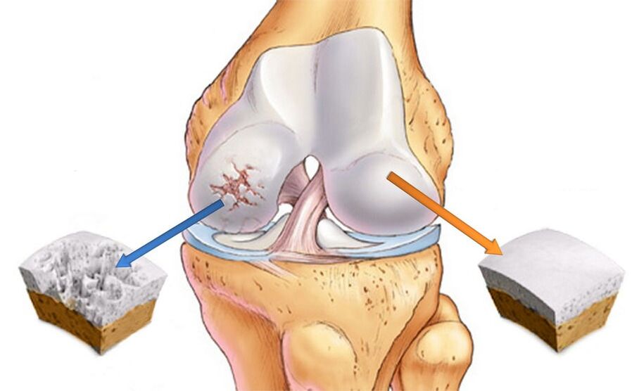 Arthrose des Kniegelenks und gesunder Knorpel. 