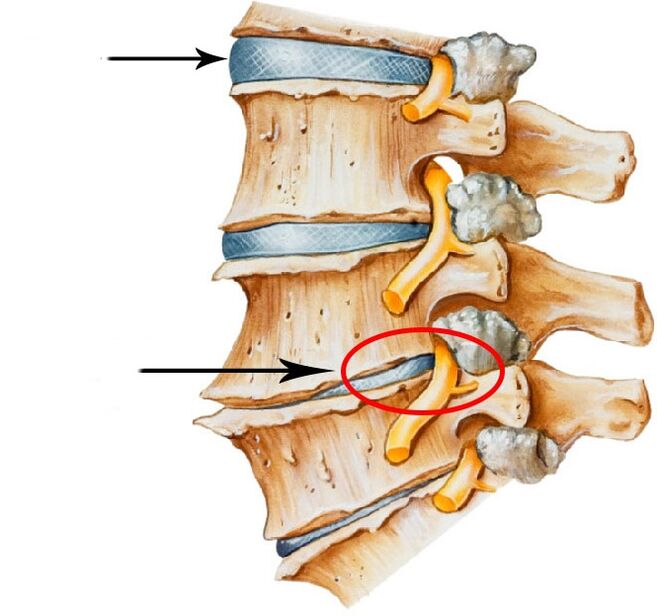Disco -Hernienentwicklung