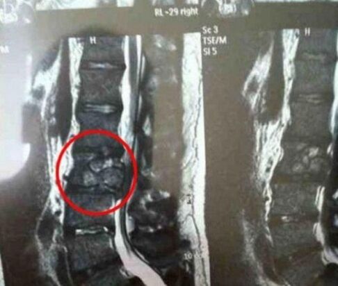 Der Tumor der Säule im Bild