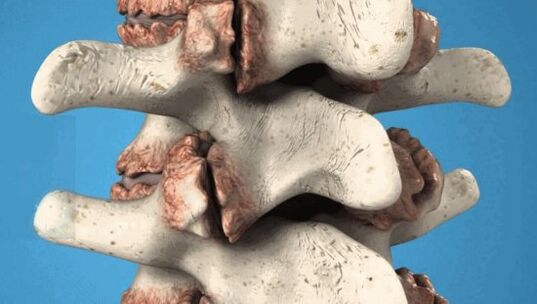 Osteophyten der pathologischen Wachstum der Wirbel, die Nerven und Blutgefäße schädigen