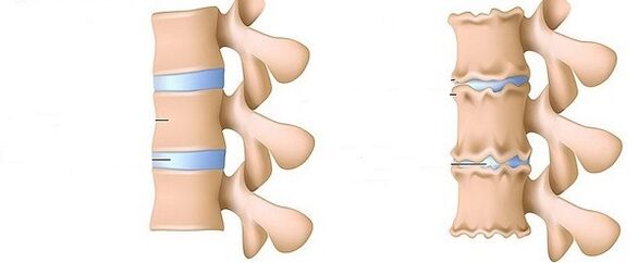 Gesunde Säule und Osteochondrose