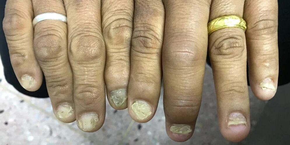 Eine Schwellung der Finger und eine Verformung der Nagelplatte können auf die Entwicklung einer Psoriasis-Arthritis hinweisen.