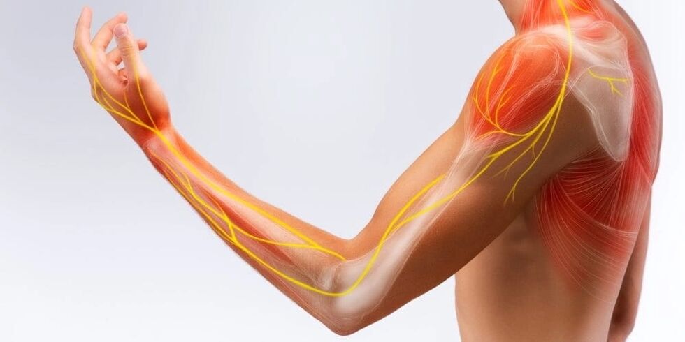 Schmerzen und Taubheitsgefühle in den Fingern weisen auf eine Schädigung der Bänder aufgrund einer stenosierenden Ligamentitis hin.