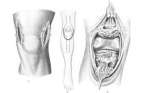 Arthrotomie-Chirurgie bei Osteoarthritis